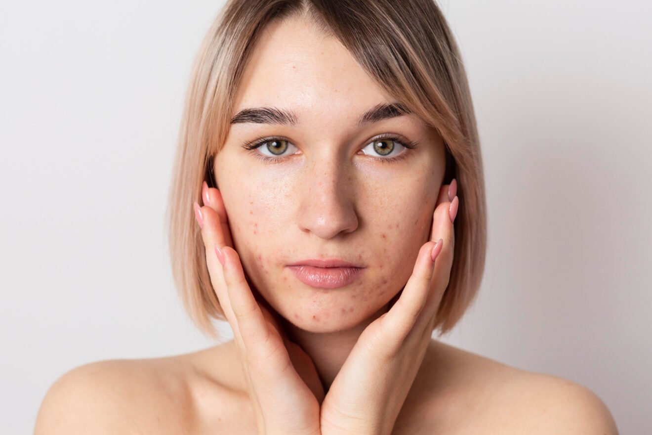 Acne & Breakouts Skin Korean Skincare Routine | Acne Skin Essentials 1 Acne & Breakout Solutions